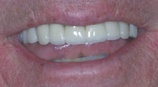 Replaced and repaired top teeth