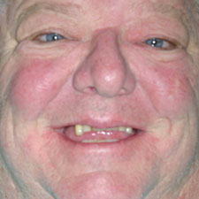 Older man with missing and damaged top teeth