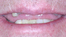 Missing and damaged top teeth