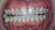 Closeup of smile before treatment