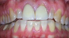 Discolored and damaged smile closeup