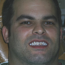 Man with discolored front teeth