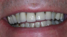 Discolored and decayed teeth closeup