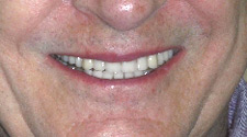 Perfectly repaired teeth